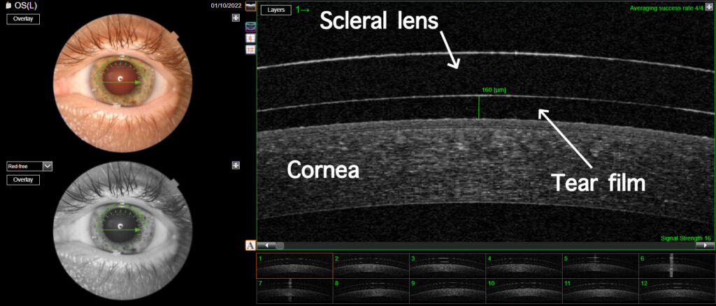 scleral fitting